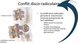 Conflit disco-radiculaire et dermatomes